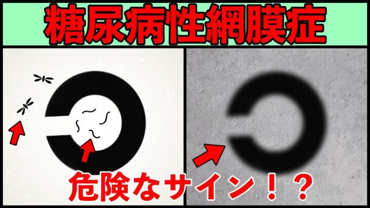 【失明の恐れ】糖尿病性網膜症のサインについて解説