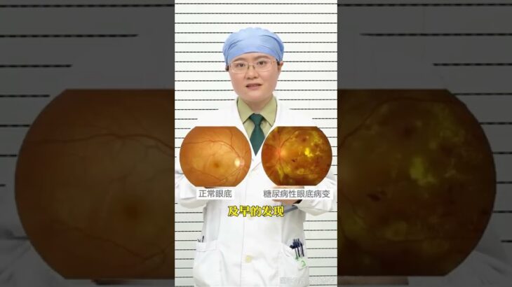 糖尿病视网膜病变应该怎样治疗？.mp4