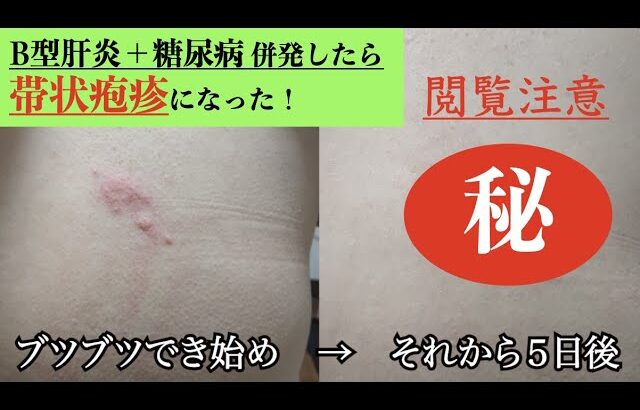 【閲覧注意！】B型肝炎→糖尿病→帯状疱疹になりました！【しのはらじお⑧】