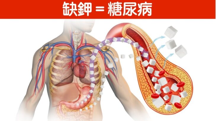 缺鉀造成糖尿病,補鉀食物,柏格醫生 Dr Berg