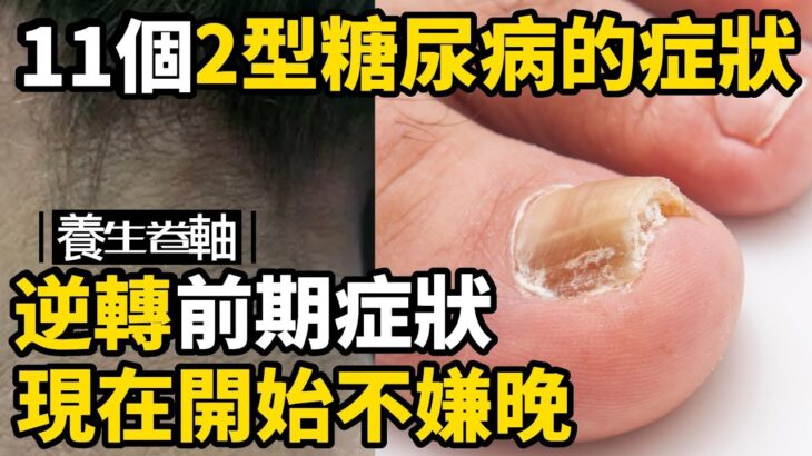 11個2型糖尿病的前期症狀 | 幫助逆轉糖尿病