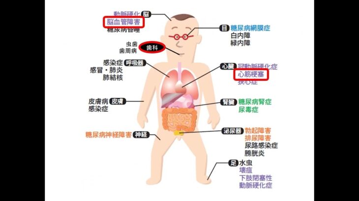 【動画】エキサイ健康教室 糖尿病について 2023年4月