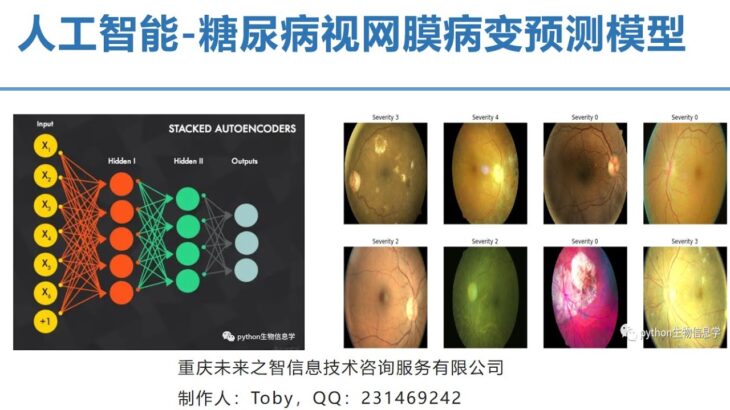 人工智能糖尿病视网膜病变预测模型 企业科研 论文 专利 AI model of diabetes retinopathy