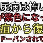 重曹クエン酸ニガリリンゴ酢をすぐにはじめる！糖尿病はすぐなおるけど放置すると怖い。足が紫色に変色した！危険。壊疽する前にやるべきこと。動画がシャドーバンされてます。