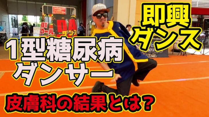 【1型糖尿病ダンサー】ダンスイベントで即興を踊りました！からの皮膚科の結果とは？