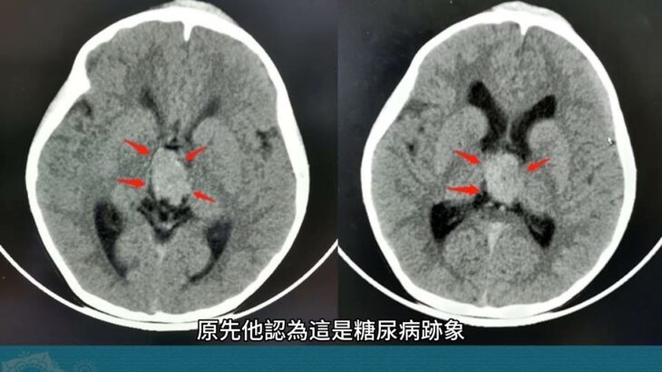 以為糖尿病！男每天灌10公升水　竟是「這裡」長腫瘤