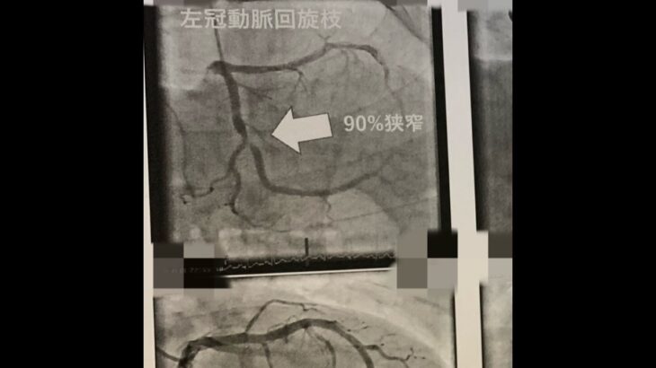 31歳糖尿病が心筋梗塞前後で食べてたごはんの動画　エンドレス 　#糖尿病 #心筋梗塞 #料理