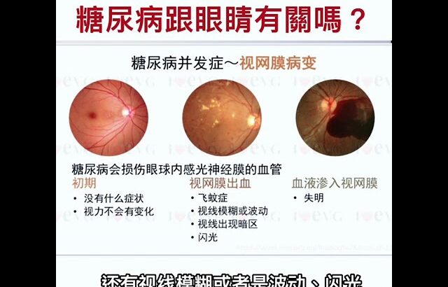 糖尿病專題（糖尿病跟眼睛有関嗎？）55