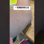 一型糖尿病生活　#一型糖尿病