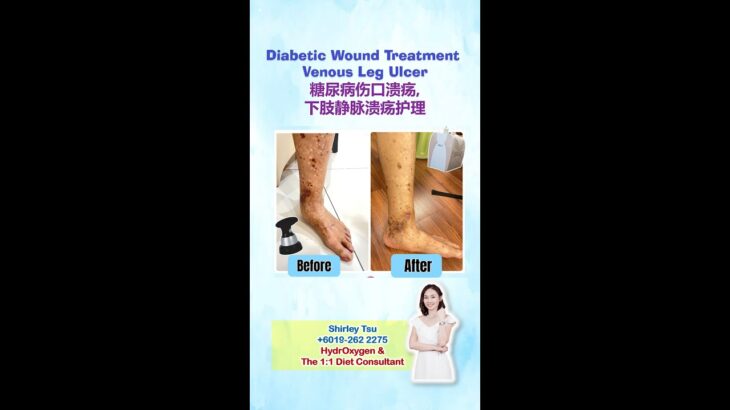 Diabetic Wound Care Treatment 糖尿病伤口溃疡护理