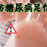 糖尿病人腳這些訊號，是「爛腳」前兆，要加強預防！