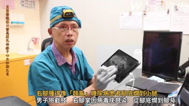 差點截肢！右腳腫得像「麵龜」糖尿病患者腳底爛到小腿