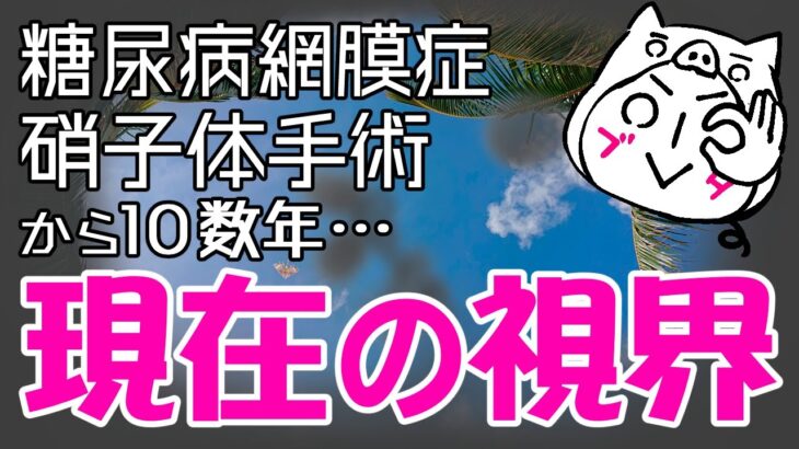 【祝☆チャンネル登録2000人】糖尿病網膜症で硝子体手術から10年後の視界について！