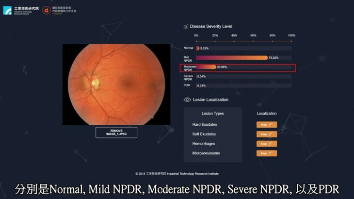 糖尿病眼部影像診斷輔助分析技術