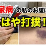 【糖尿病 Type1 】糖尿病の私のお腹は…もはや打撲状態！痛する原因はわかっていても…