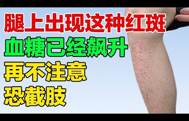 腿上出现这种红斑，血糖已经飙升，糖尿病人赶快看【养生有道】