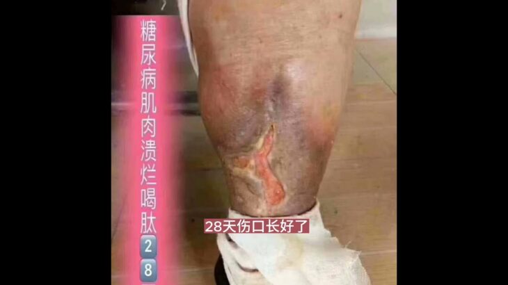 糖尿病并发症，肌肉溃烂，28天不需要截肢了