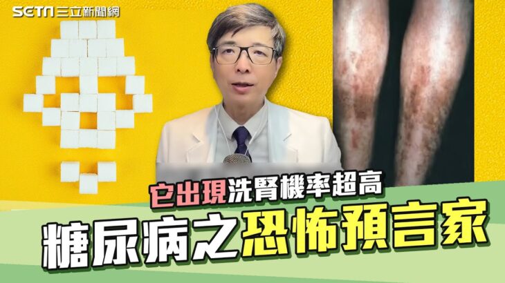 糖尿病恐怖預言家！拉褲管一看驚見「糖斑」醫師揭密糖尿病併發症 它一出現洗腎機率超高！冠心病、視網膜病變、糖尿病足通通來…超強5招逆轉 #糖尿病脛前黑斑｜腎寶思樂腎臟專科｜祝你健康