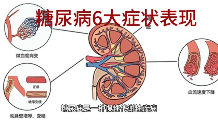 糖尿病6大症状表现