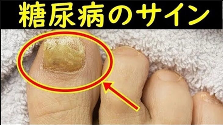 糖尿病の危険なサインがコレ！糖尿病を疑うべき症状やなりやすい人のタイプとは？