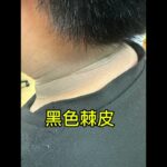 #黑色棘皮 #肥胖 #糖尿病 #兒科醫師洪毓棋