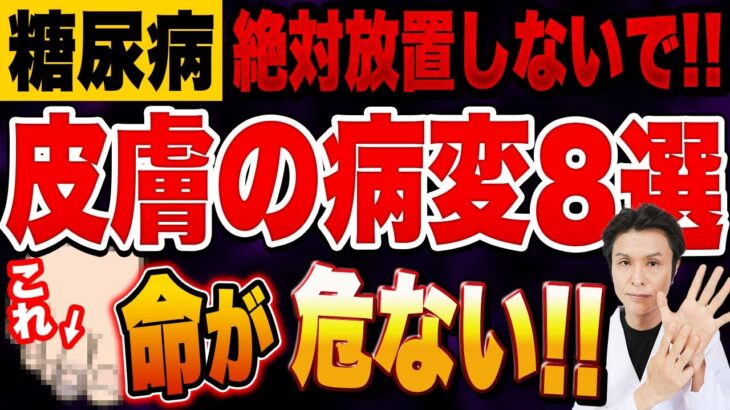 糖尿病と皮膚病変：皮膚科医が教える知っておきたい８つの症状