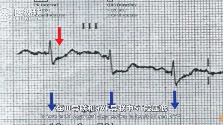 【医学双语课程】心电图 第五课：一例糖尿病患者的心电图