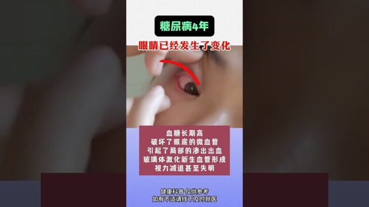 糖尿病对眼睛的伤害！ #糖尿病性视网膜病变  #健康  #中医眼科 