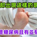 腿部出現這樣的現象，可能是糖尿病且有並發癥了#養生保健#健康#健康飲食