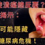 口腔潰瘍總反覆？醫生揭示：背後可能隱藏的糖尿病危機！知道早受益！【幸福老人生】#糖尿病#口腔潰瘍