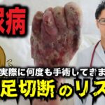 「糖尿病 と足 の切断 リスク 」 糖尿病 患者 必見！合併症 予防 と足 の健康管理法