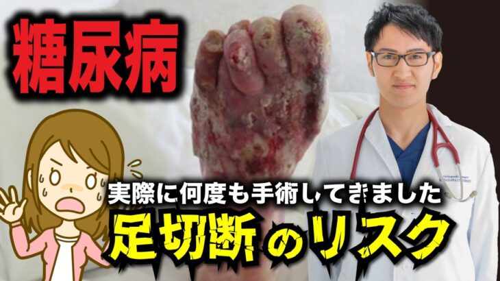 「糖尿病 と足 の切断 リスク 」 糖尿病 患者 必見！合併症 予防 と足 の健康管理法