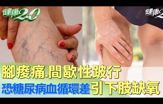 腳痠痛.間歇性跛行 恐糖尿病血循環差引下肢缺氧 健康2.0 @tvbshealth20