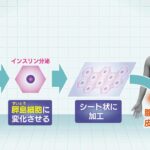 『ｉＰＳ細胞』から“膵臓の組織”を作製し移植　「１型糖尿病」患者への治験を来年にも開始　京都大学附属病院（2024年9月2日）