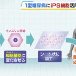 『ｉＰＳ細胞』を活用した「１型糖尿病」患者への治験を来年にも開始　膵島細胞を作製しシート状に加工して患者へ移植　京都大学附属病院（2024年9月2日）