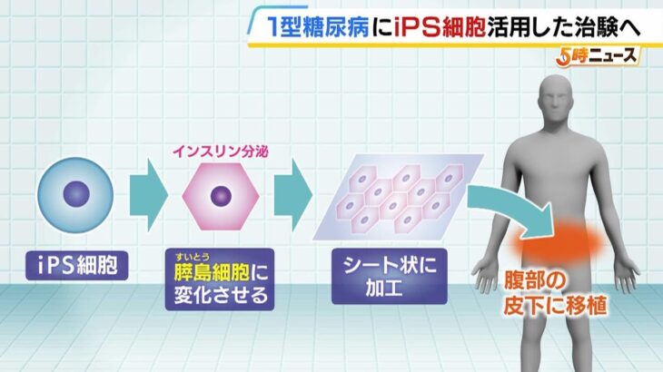 『ｉＰＳ細胞』を活用した「１型糖尿病」患者への治験を来年にも開始　膵島細胞を作製しシート状に加工して患者へ移植　京都大学附属病院（2024年9月2日）