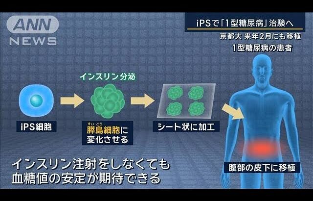 来年2月にも移植…iPS細胞で『1型糖尿病』治験へ　2030年以降の実用化目指す　京都大【報道ステーション】(2024年9月2日)