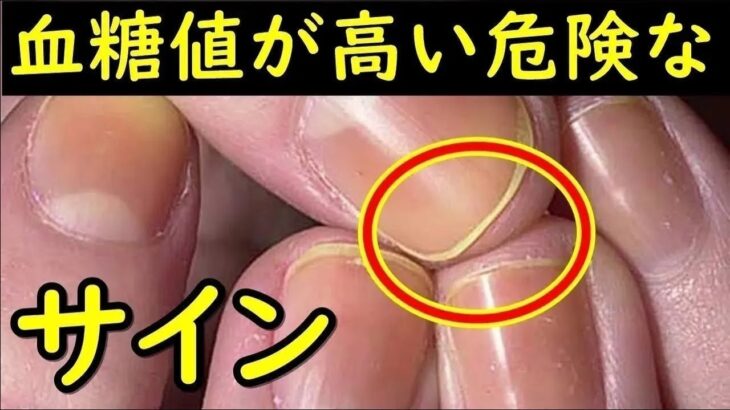 【糖尿病】血糖値が高すぎることを教えてくれる重要なサイン！高血糖症とは？