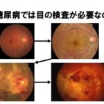 糖尿病と目の検査