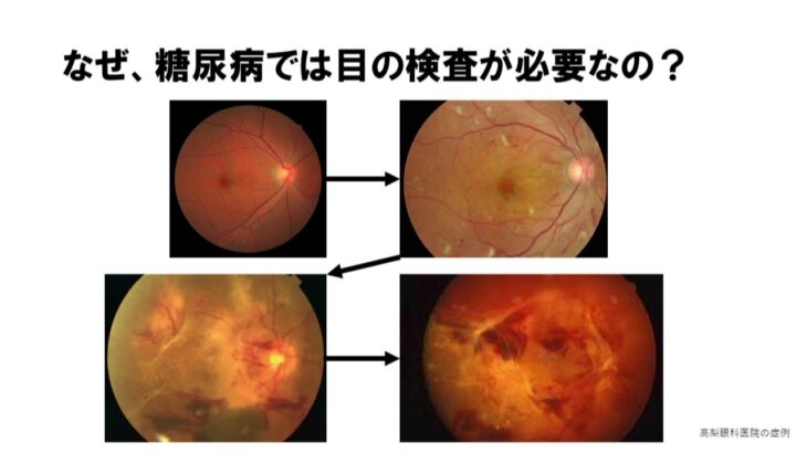 糖尿病と目の検査