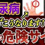 絶対に放置するな！糖尿病によって「手」に現れる症状とは”