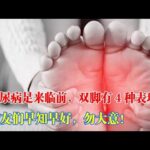 【糖尿病足】糖尿病足來臨前，雙腳有4種症狀！糖友們早知早好，勿大意！ #糖尿病 #血糖 #糖尿病足