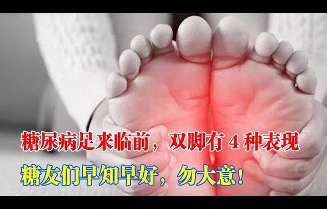 【糖尿病足】糖尿病足來臨前，雙腳有4種症狀！糖友們早知早好，勿大意！ #糖尿病 #血糖 #糖尿病足