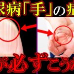 知らないとヤバい！糖尿病「手」からの危険サイン4選！【注意な合併症】初期症状を簡単解説【高血糖｜食事｜ヘモグロビンa1c｜予防｜HbA1c】