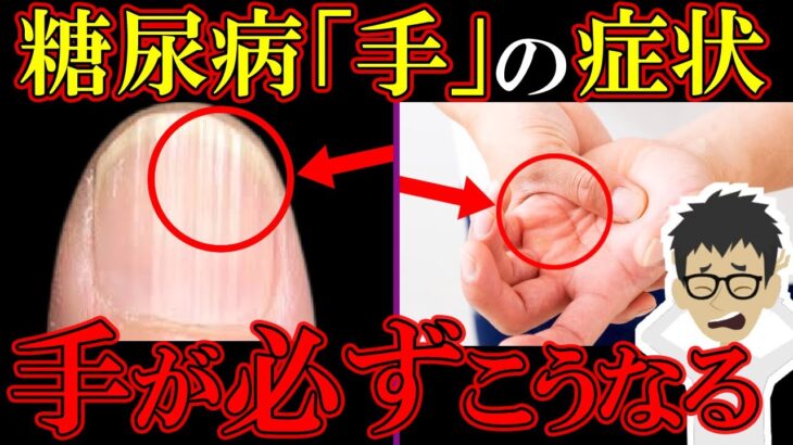 知らないとヤバい！糖尿病「手」からの危険サイン4選！【注意な合併症】初期症状を簡単解説【高血糖｜食事｜ヘモグロビンa1c｜予防｜HbA1c】