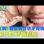 雙生病! 糖尿病合併牙周病 牙齦出血.牙齒鬆脫 健康2.0 @tvbshealth20