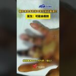 糖尿病患者剪指甲致手指远端溃烂，医生：可能会截肢。