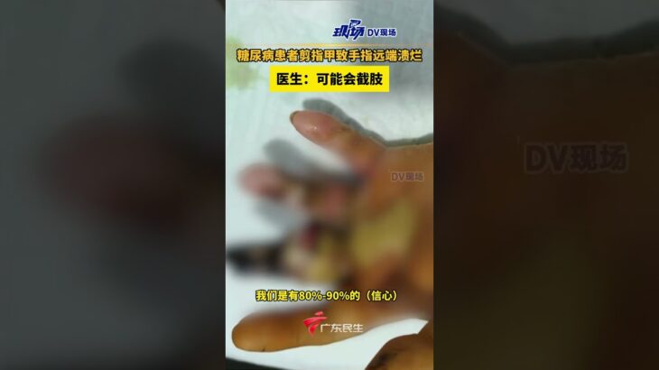 糖尿病患者剪指甲致手指远端溃烂，医生：可能会截肢。