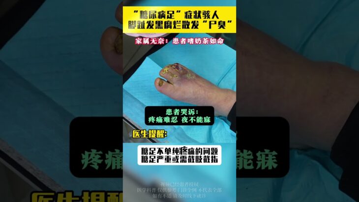 糖尿病足症状骇人，脚趾发黑腐烂散发“尸臭” 抖出健康知识宝藏   沈阳二四二医院  王强教授   糖尿病足 糖尿病周围神经病变