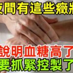 糖尿病人註意：夜間有這些癥狀，說明血糖高了，要抓緊控製了！#健康常識#養生保健#健康#健康飲食